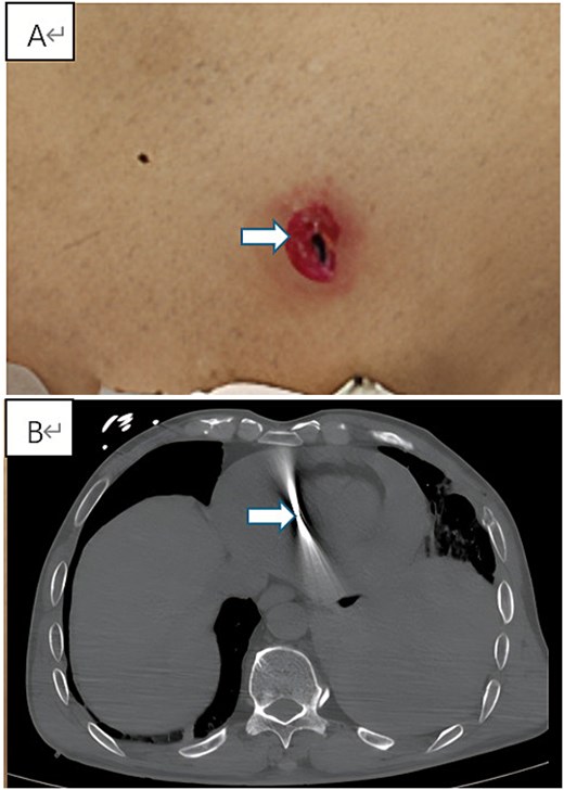 Preoperative clinical and imaging findings. (A) Photograph showing the spindle-shaped entry wound (0.5 × 1.0 cm) on the left anterior chest wall (indicated by arrow). (B) Axial view of contrast-enhanced chest CT revealing the metallic foreign body within the cardiac silhouette with radiopaque artifacts, accompanied by pericardial effusion and left hemothorax.