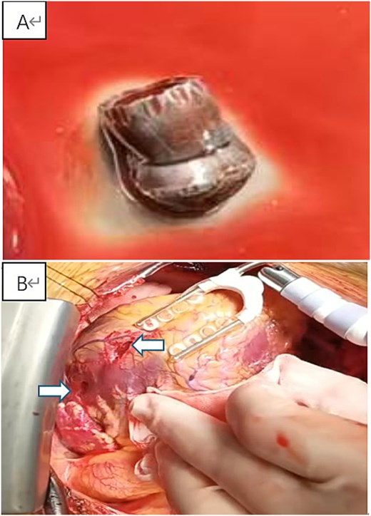 Intraoperative findings and retrieved foreign body. (A) The retrieved cylindrical metallic foreign body measuring ~1 cm in length. (B) Intraoperative view after median sternotomy, showing the cardiac laceration site on the left ventricular lateral wall.