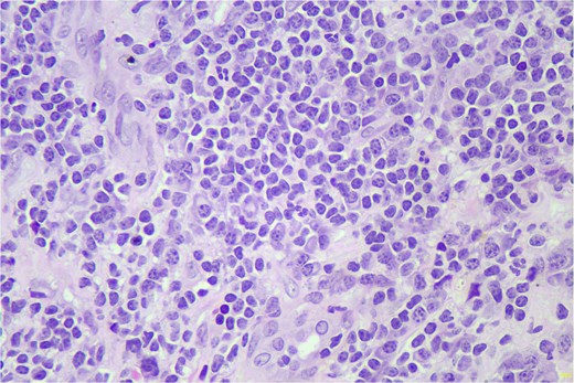 Figure 1 showing small lymphoid cells seen in sheets, H&E stain. 400x.