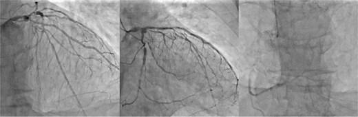 Preoperative coronary angiography. Preoperative coronary angiography image showing severe triple-vessel disease.