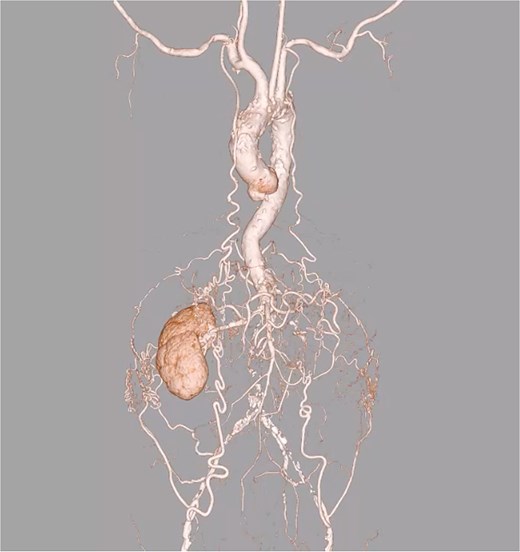 Preoperative 3D CT angiography of the entire vasculature. Preoperative 3D CT angiography image of the entire vasculature demonstrates that the ITAs are an important source of blood flow to the lower limbs.