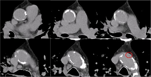 Preoperative contrast-enhanced CT of the ascending aorta. The ascending aorta is diffusely calcified. A region near the origin of the brachiocephalic artery is considered suitable for arterial cannulation. A proximal site above the fat band is also identified as appropriate for SVG anastomosis.