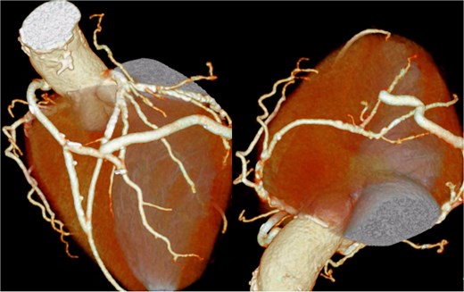 Postoperative coronary 3D CT angiography. Postoperative cardiac 3D CT image showing the final graft configuration. A SVG was anastomosed to the left anterior descending artery. Another SVG segment was joined end-to-side to construct a T-composite graft. This composite SVG was sequentially anastomosed to the diagonal branch, obtuse marginal branch, atrioventricular branch, and posterior descending branch. After revision because of torsion just distal to the diagonal anastomosis, the distal SVG segment was re-anastomosed end-to-side to the SVG connected to the diagonal branch, resulting in the final graft arrangement demonstrated in this image.