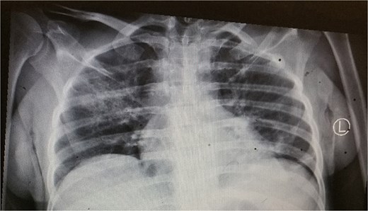 Chest X-ray showing consolidations in the right lung.