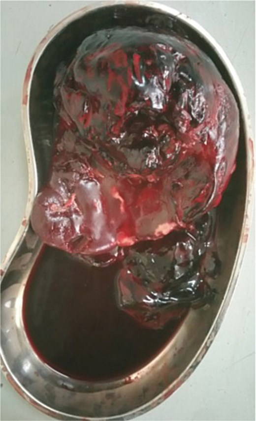 Intraoperative picture showing a ruptured spleen.