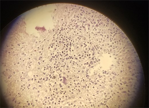 Microscopic slide of the specimen, which is consistent with splenic TB.