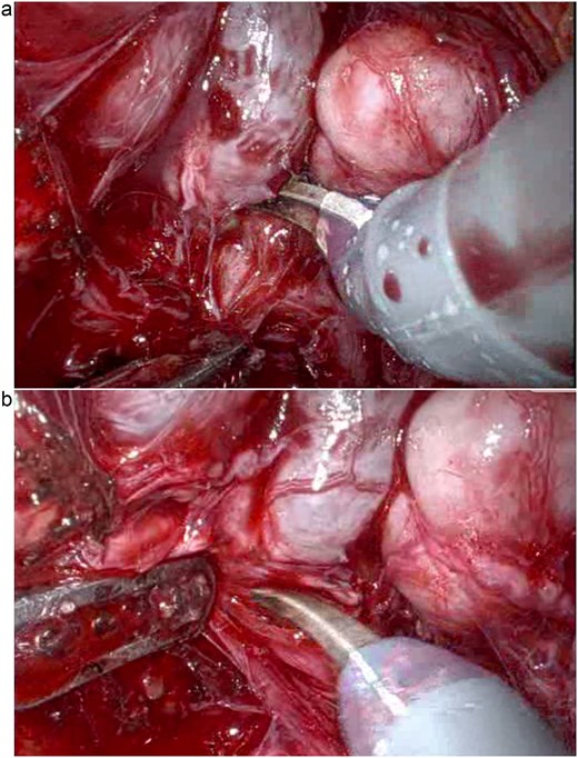 Posterior pelvic dissection demonstrating the challenging plane in the absence of normal perirectal fat (a and b).
