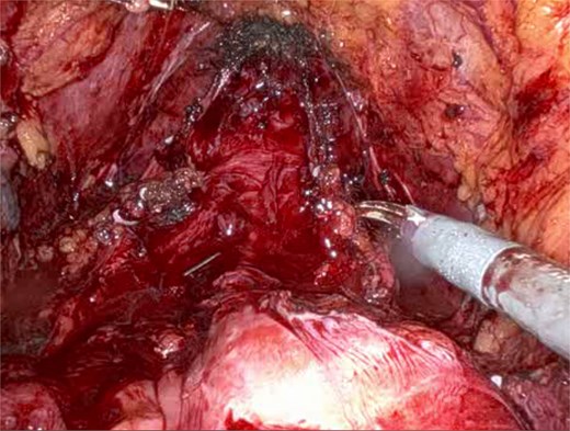 Intraoperative view showing the J-pouch after removal of the bladder and prostate.
