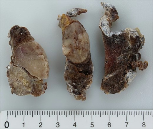 Sections of the left thyroid lobe and isthmus showing follicular neoplasia. A papillary carcinoma is visible in the lower part of the first section.