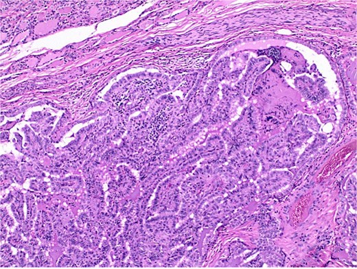 Histological section of papillary carcinoma showing papillary architecture, clear nuclei, and nuclear membrane thickening.