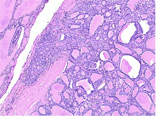 Histological section of follicular carcinoma demonstrating capsular invasion through its full thickness.