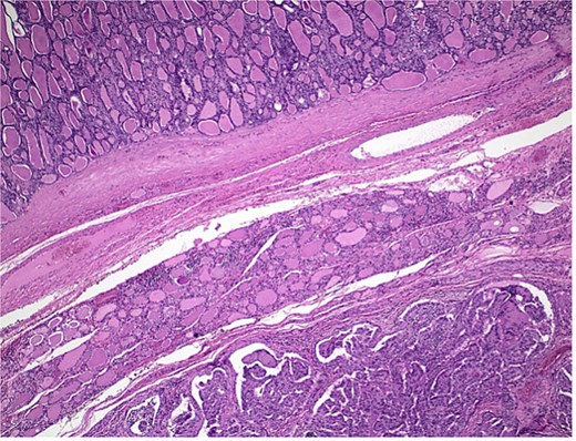 Histological section showing follicular carcinoma in the upper region and papillary carcinoma in the lower region, with intervening non-neoplastic thyroid tissue.