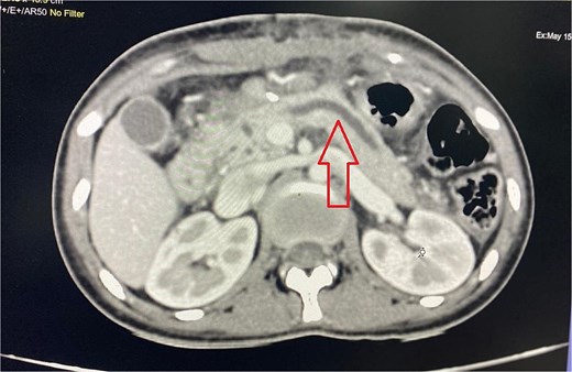 Abdominal CT showing dilated pancreatic duct.