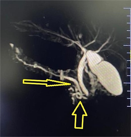 MRCP showing abnormal pancreatic duct anomaly.