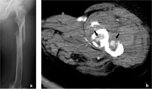 Imaging tests of the left femur. (a) Radiograph showing a fracture of the left femoral shaft. (b) Contrast-enhanced computed tomography showing the tumour strain around the fracture site.