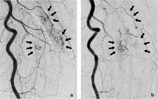Lower extremity angiography. (a) Pre-embolization angiography showing tumour blush in the femur. (b) Post-embolization angiography showing tumour devascularization.