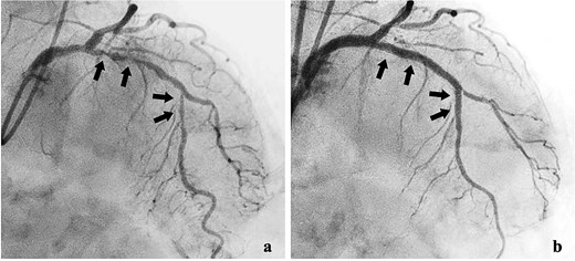 Coronary angiography findings. (a) Pre-treatment angiography showing 90% stenosis of the left anterior descending artery. (b) Post-treatment angiography showing improved blood flow in the left anterior descending artery after percutaneous coronary intervention.