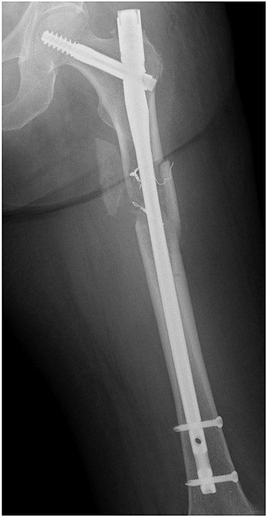 Postoperative radiograph of the left femur.