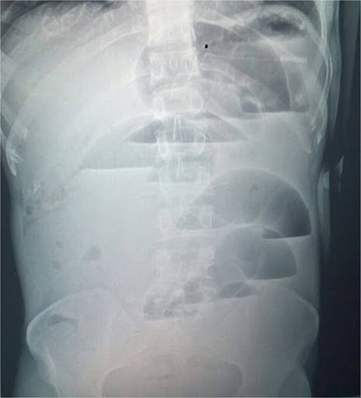 Erect abdominal radiograph showing multiple air–fluid levels and dilated bowel loops.