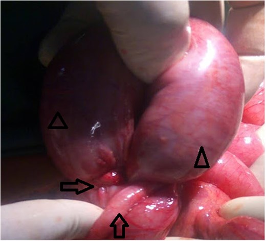 Inflamed appendix forming a constricting ring (arrow) around a loop of viable distal ileum (arrow head).