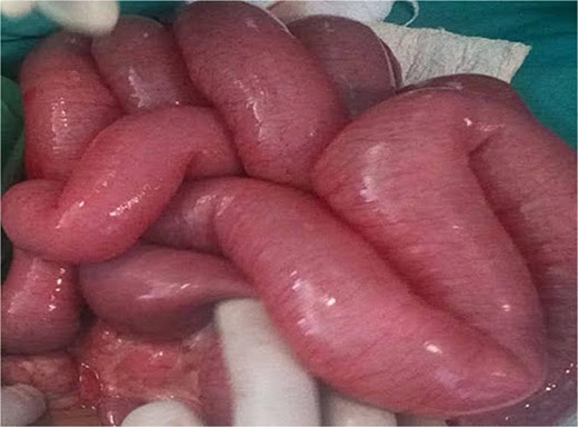 Viable distended proximal small bowel loops.