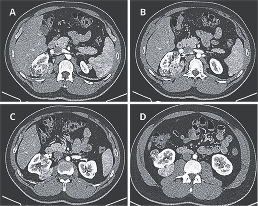 Preoperative CT scan. (A) Axial CT scan showing AML surrounding the right diaphragmatic crus. (B–D) Lesions composed of fat and soft-tissue densities in the upper, middle, and lower poles of the right kidney extending into adjacent retroperitoneal structures.