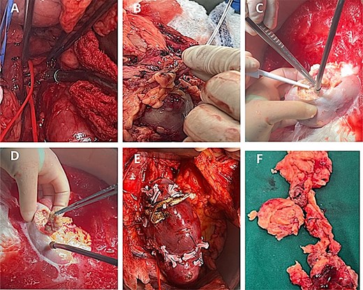 Surgical procedure. (A) Identification of the renal artery posterior to the inferior vena cava. (B) Arterial perfusion with histidine–tryptophan–ketoglutarate (Custodiol®) solution. (C-D) Hydrodissection of the AML under ultrasound guidance. (E) Renorrhaphy with barbed 3–0 Stratafix™ sutures, reinforced with Hem-o-lok® clips and oxidized cellulose. (F) Excised tumour specimens following bench surgery.