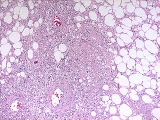 Histopathological features. Spindle-shaped smooth muscle cells without atypia or mitoses, interspersed with mature adipose tissue and variably sized vessels showing transmural hyalinization.