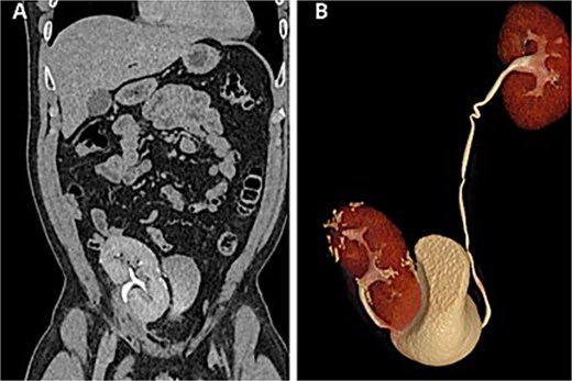 Postoperative CT scan. (A) Autotransplanted right kidney in the iliac fossa demonstrating symmetric contrast excretion and no residual lesions. (B) Normal calyceal morphology and nondilated pelvis; ureters with normal course and caliber.