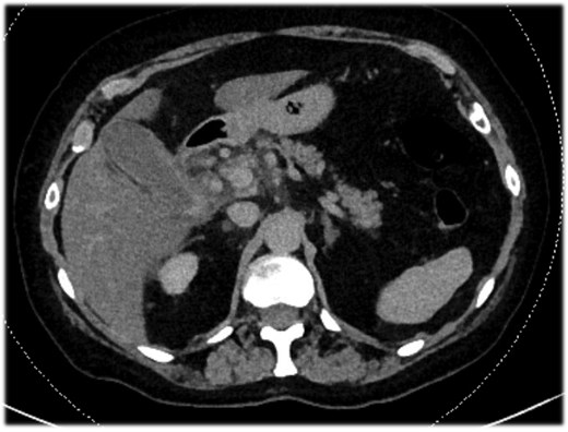 Abdominal-CT of patient at admission, revealing signs of acute calculous cholecystitis.