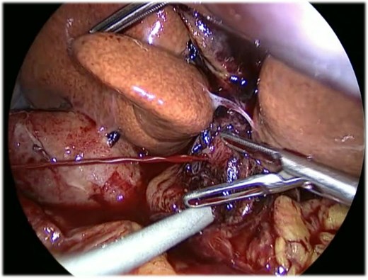 Intraoperative laparoscopic image showing massive spontaneous arterial bleeding on the hepatic pedicle before vascular clamping and conversion to open surgery.