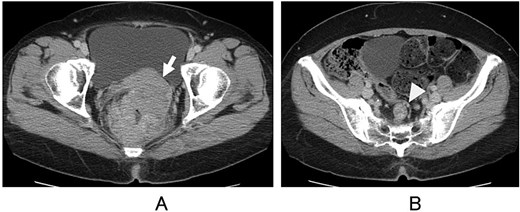Computed tomography. Direct invasion of the uterus (A, arrow) and regional lymph node metastasis (B, arrowhead) are shown.