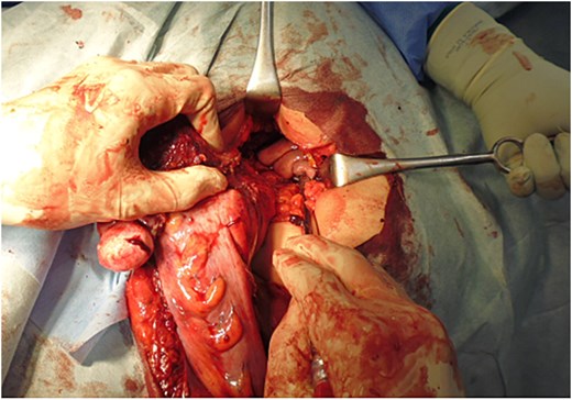 Specimen extraction. With the patient in the right lateral decubitus position, the proximal end of the colon was extracted, and the specimen remained attached to the posterior vaginal wall.