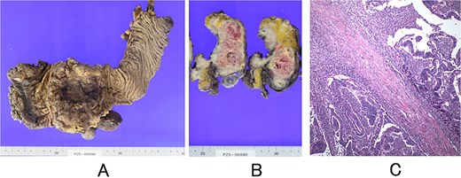 Resected specimen and histopathology. (A) Surface of the rectum after surgical removal. (B) Cross-section showing invasion of the uterus. (C) Microscopic findings showing moderately to well-differentiated tubular adenocarcinoma with direct invasion into the uterus (haematoxylin and eosin stain; original magnification, ×100).