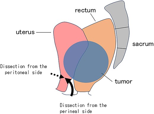 Schematic illustration of the uterine resection. Dissection from the peritoneal side (dotted arrow) and from the perineal side (solid arrow) is shown.