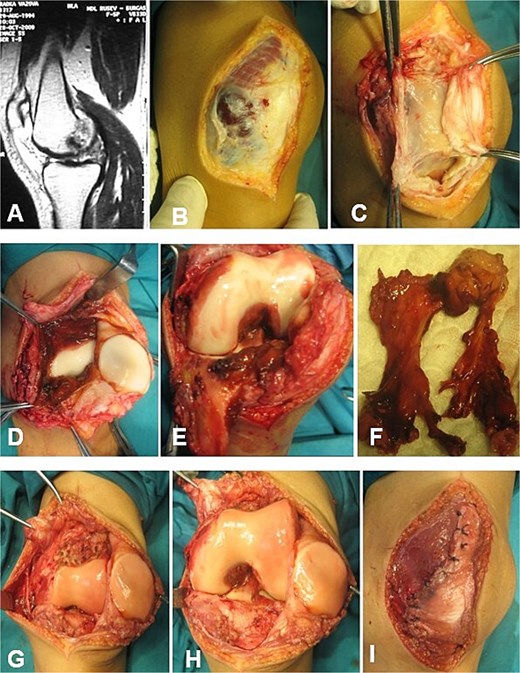 Open synovectomy for D-TGCT of the left knee in a 15-year-and-6-month-old female patient. Case 7. (A–C) Medial parapatellar approach. The neoplasm becomes clearly visible following incision of the fibrous capsule. (D–F) Extensive involvement of the SR, sup/inf IR, and CR. (G and H) Articular surfaces following sharp and electrocautery-assisted removal of the pathological synovium. All accessible and visibly affected areas, including those surrounding the cruciate ligaments, were completely excised. The cruciate ligaments and menisci remained intact. (I) Restoration of the fibrous capsule. CR, cruciate recess; SR, suprapatellar recess, sup/inf IR, superior/inferior infrapatellar recesses.