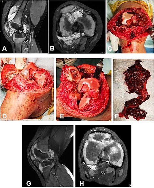 Case 1. (A and B) Preoperative T1 sagittal and axial MRI sequences with PD FS. (C and F) Macroscopic appearance of the pathological synovium before and after its excision. (D and E) The knee joint following synovectomy, demonstrating intact menisci and cruciate ligaments. Chondral lesions correspond to Outerbridge grade IV. (G and H) Postoperative 24 m. Sag and Ax MRI PD FS. No evidence of recurrence of the resected neoplasm was detected. Residual TGCT involvement persists within the lateral posterior femoral recesses. PD FS, proton density weighting with fat suppression; TSE, turbo spin echo.