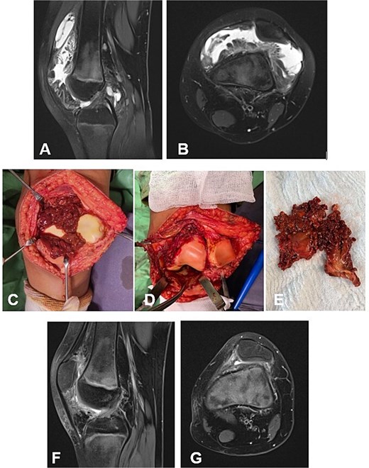 Case 2. (A and B) Preoperative Sag and Ax MRI weighted TSE PD FS. (C and E) Macroscopic appearance of the pathological synovium before and after its excision. (D) The knee joint following synovectomy. Chondral lesions correspond to Outerbridge grade I. (F and G) Postoperative 16 m. Sag and Ax MRI TSE PD FS—no evidence of recurrence of the resected neoplasm. Persistent bone marrow edema, though without clinical symptoms. PD FS, proton density weighting with fat suppression; TSE, turbo spin echo.