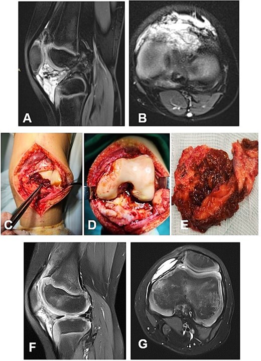 Case 3. (A and B) Preoperative sag and ax MRI TSE PD FS. (C and E) Macroscopic appearance of the pathological synovium before and after its excision. (D) The knee joint following synovectomy. Chondral lesions correspond to Outerbridge grade I. (F and G) Postoperative 12 m. Sag and Ax MRI TSE PD FS—no evidence of recurrence of the resected neoplasm. PD FS, proton density weighting with fat suppression; TSE, turbo spin echo.