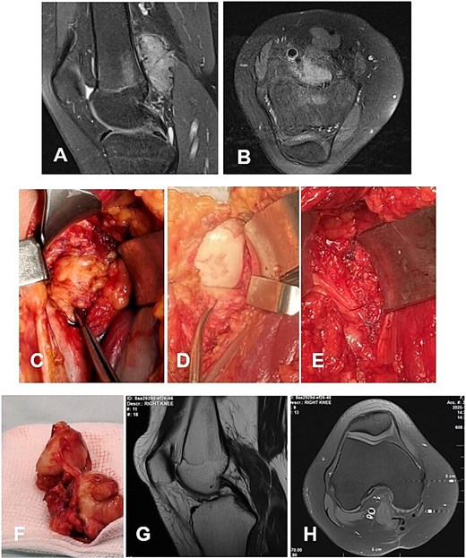 Case 4. (A and B) Preoperative Sag and Ax MRI TSE PD FS—a lobulated intra-articular neoplasm with a posterior mediocentral localization, displacing the neurovascular bundle laterally. (C and F) Macroscopic appearance of the N-TGCT measuring 3 × 1 × 2 cm, in situ and after excision. (C) Posterior synovectomy performed with lateral retraction of the m. gastrocnemius medialis. (D) The joint after synovectomy, showing grade I chondral changes according to the Outerbridge classification. (E) Reconstructed fibrous capsule. (E and F) Postoperative 12-month sagittal and axial MRI (TSE PD FS) demonstrates no evidence of recurrence of the resected neoplasm. (G and H) PD FS, proton density weighting with fat suppression; TSE, turbo spin echo.