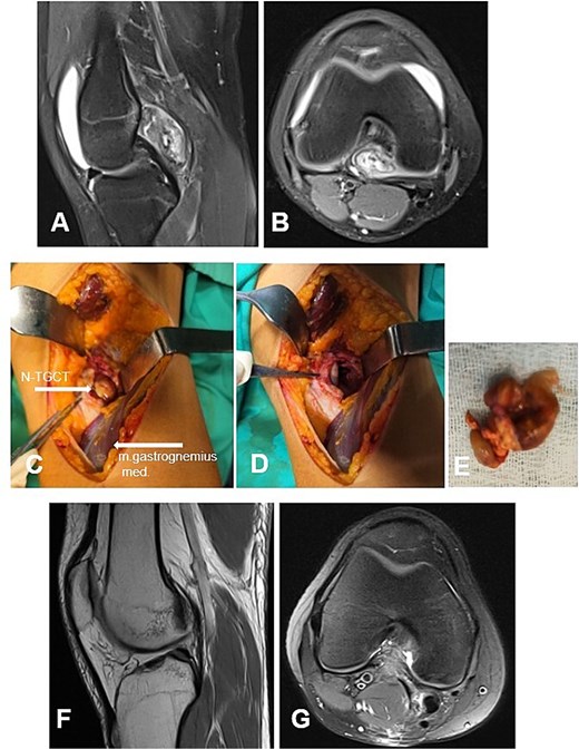 Case 5. (A and B) Preoperative sag and ax MRI TSE PD FS—lobulated edematosus intra-articular neoplasm with a posterior mediocentral localization. (C and D) Posterior synovectomy between m. semitendinosus and m. gastrognemius medialis. (Е) Macroscopic appearance of the N-TGCT measuring 3 × 2 × 2 cm after excision. (F and G) Postoperative 12 m. Sag and Ax MRI TSE PD FS—no evidence of recurrence of the resected neoplasm. PD FS, proton density weighting with fat suppression; TSE, turbo spin echo.