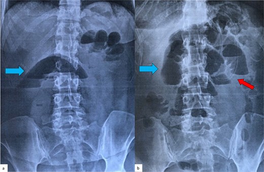 Plain abdominal radiograph of the patient (first case) in an upright position, on admission (a) and 48 hours later (b). Air-fluid levels (blue arrows), typical of small bowel obstruction, are clearly seen in both films, with no signs of improvement after conservative treatment with a nasogastric tube (red arrow).