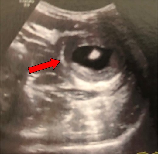 Ultrasound examination of the patient (second case) on admission. The typical ‘target sign’ (arrow) is clearly demonstrated, raising the suspicion of a bowel intussusception.