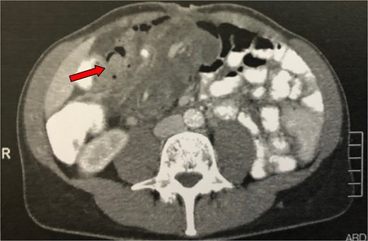 Abdominal CT of the patient (second case) showing an abdominal ‘mass’ (arrow), consisting of intestinal loops forming a multilayer concentric ring, expanding from the ileocolic valve till the left upper abdomen and suggesting an ileocolic intussusception.