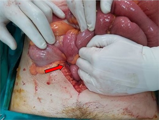 Intraoperative picture of the second case. The point of intusssception is annotated with an arrow.
