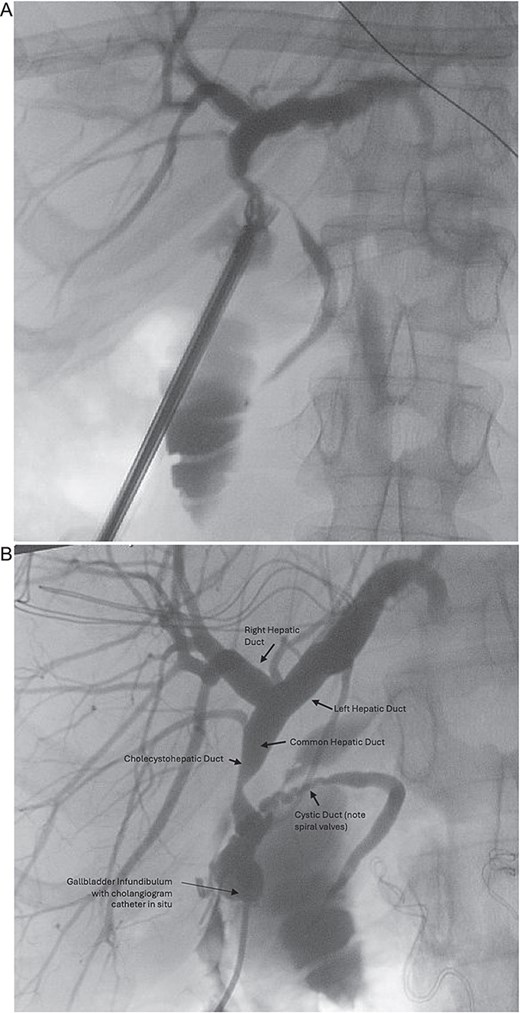 (A) Initial intra-operative cholangiogram, difficult to interpret biliary anatomy. (B) Intra-operative cholangiogram once converted to open, revealed the common hepatic duct was draining directly into the gallbladder infundibulum from the liver, and that the entire biliary drainage from the gallbladder to the ampulla of Vater was via the cystic duct.