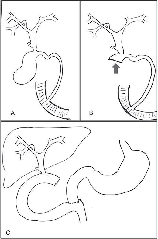 (A) Cholecystohepatic duct draining into infundibulum of gallbladder and then via cystic duct to ampulla of Vater. (B) Biliary anatomy following reconstituting subtotal cholecystectomy preserving infundibulum (arrow). (C) Anatomy of bile ducts and drainage following hepaticojejunostomy reconstruction.