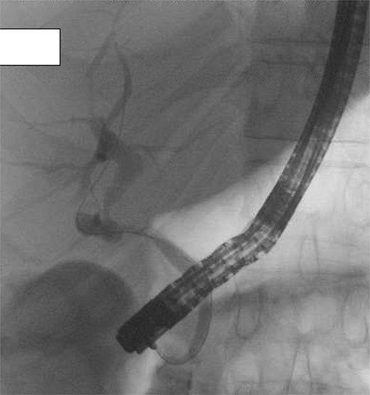 Post-operative ERCP demonstrating no filling defects, large stones, or extrinsic compression. Contrast drains from the liver into common hepatic duct and then via an elongated infundibular–cystic duct channel to the duodenum, supporting the diagnosis of a cholecystohepatic duct.