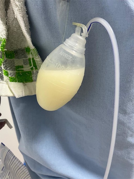 Drainage with milky characteristics.