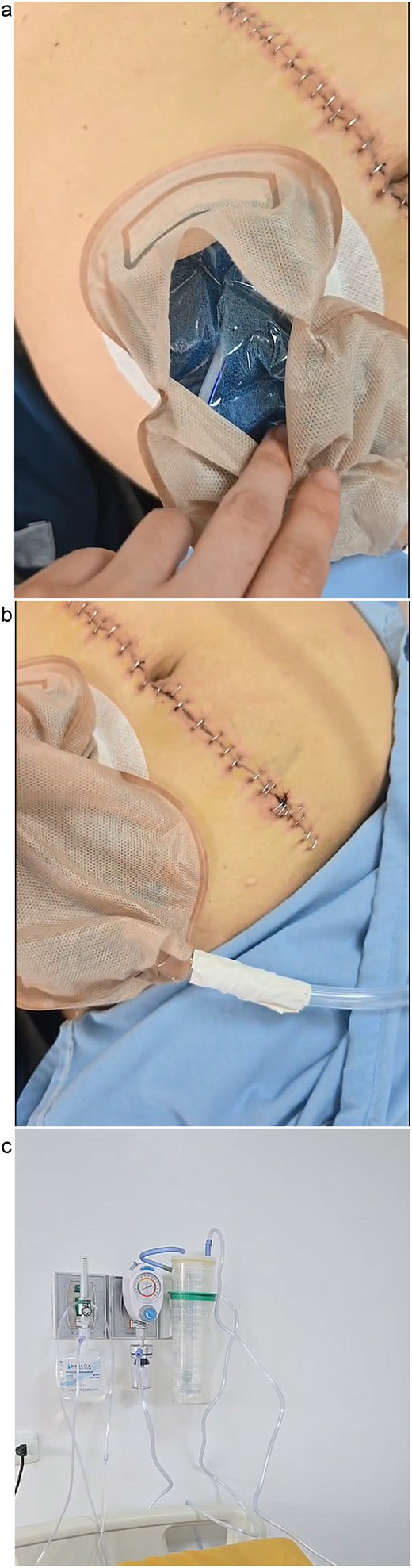 (a) Suction sponges in ostomy bag. (b) Suction hose connection to ostomy sheath. (c) Suction system connection to wall with negative pressure.